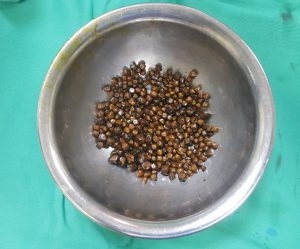 Gần 400 viên sỏi được lấy ra khỏi túi mật nữ bệnh nhân. (Ảnh: Bệnh viện cung cấp)