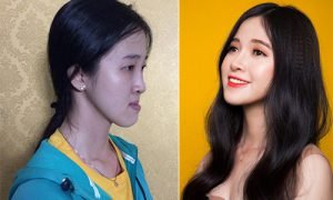 Gương mặt Thảo trước và sau phẫu thuật thẩm mỹ. Ảnh: H.T.