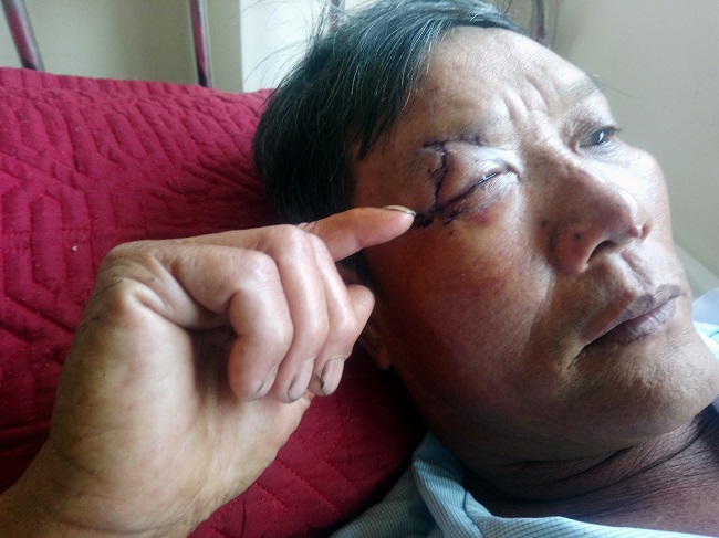 Ông Võ Văn Lẹ - một nạn nhân khác đang được cấp cứu tại bệnh viện do bị "cát tặc" đánh trọng thương ở mắt.