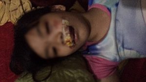 Bé N.T.A.T bị chó cắn khâu 13 mũi