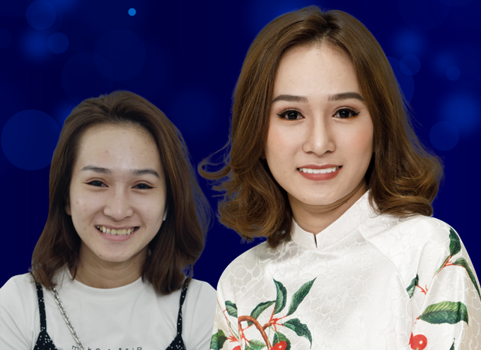 Thanh Thúy xinh đẹp hơn nhiều sau khi làm răng sứ.