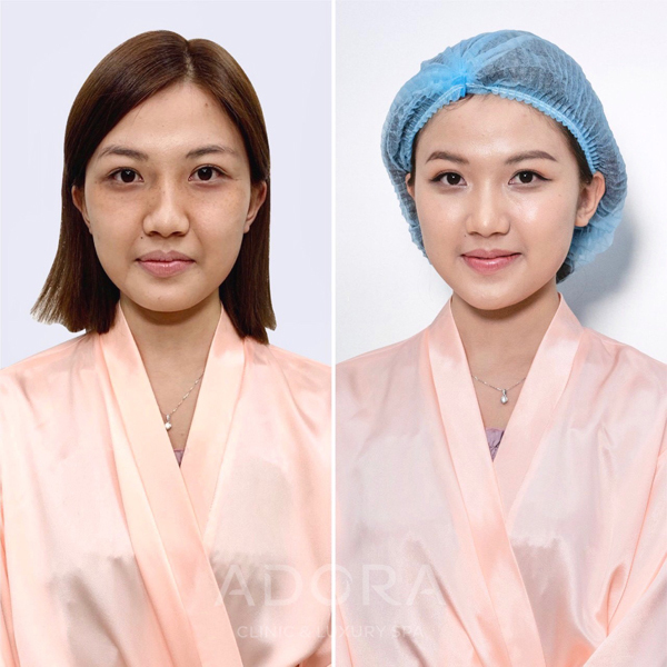 Làn da của Lương Thanh thay đổi tích cực sau khi thực hiện chăm sóc da công nghệ Adosilk Collagen