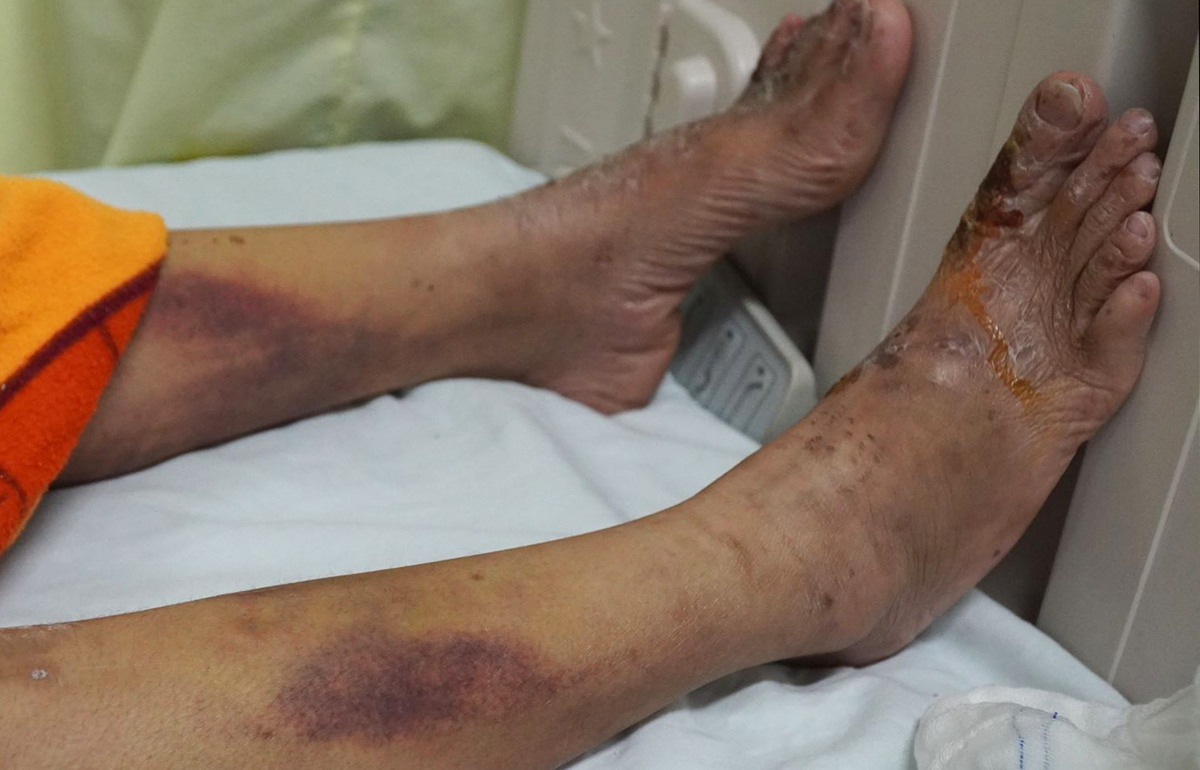 Sau 10 ngày bị đánh, vết thương trên đôi chân nạn nhân vẫn bầm tím. Ảnh: Phước Tuấn.