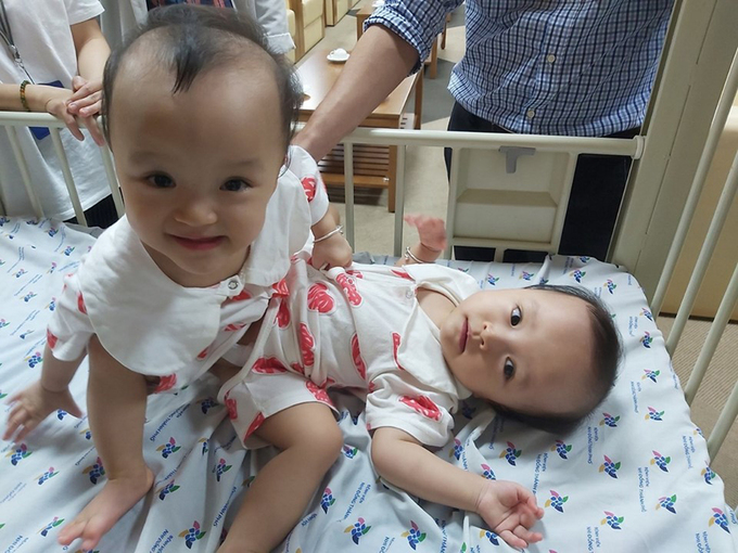 Hai bé tập sống chung trong tư thế dính nhau, suốt 13 tháng đầu đời. Hai chị em thể hình tương đối bằng nhau, tổng cân nặng hiện tại 15 kg. Ảnh do bệnh viện cung cấp.