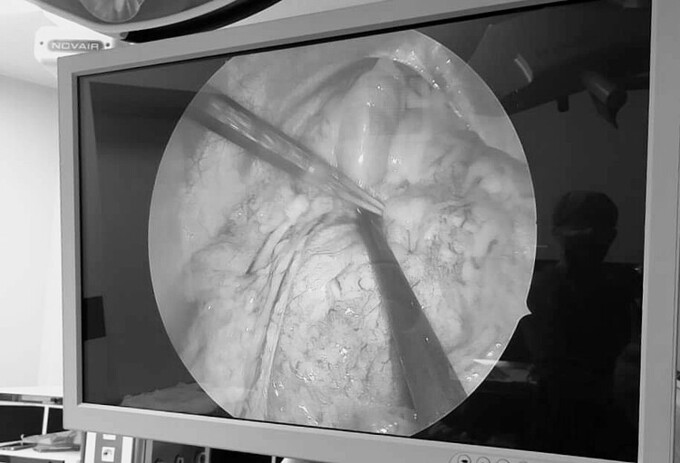 Hình ảnh toàn bộ ruột non chui qua lỗ thoát vị nằm trên khoang màng phổi trái. Ảnh: Bệnh viện cung cấp